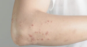 dị ứng hạt điều